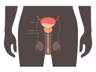 dysurie zvětšená prostata